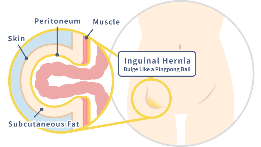 What Are Inguinal Hernias?